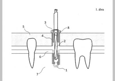 Process for the dynamic determination of the length of drill and guide used for dental implantation surgery