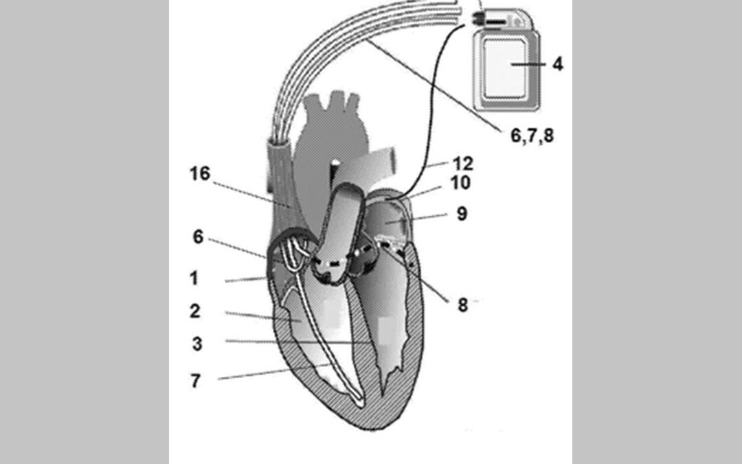 Apparatus for recovering and stabilizing normal heart rate of patients suffering from or being inclined to having atrial fibrillation