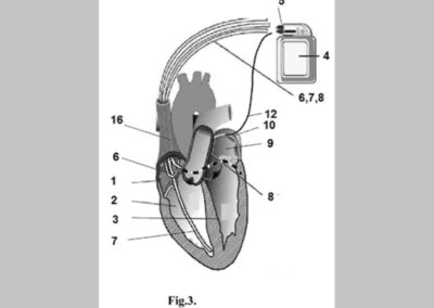 Apparatus for recovering and stabilizing normal heart rate of patients suffering from or being inclined to having atrial fibrillation